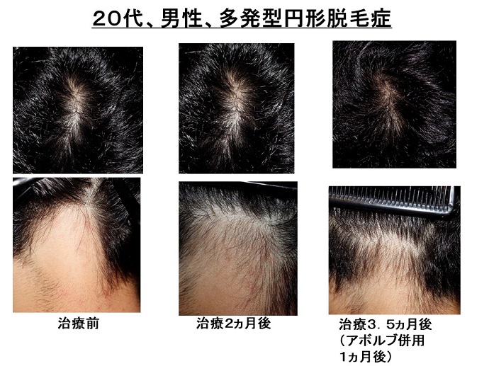 円形脱毛症　病院